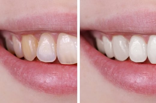 Whiten your teeth safely and naturally -- Health & Wellness -- Sott.net