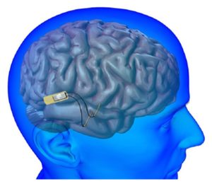 Brain implants becoming practical with new technology -- Science ...