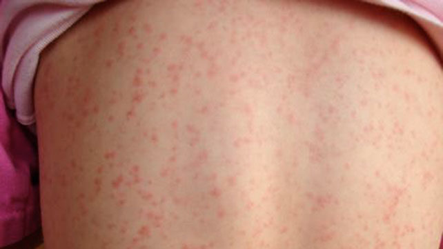 Scarlet Fever Is Back And Every Parent Needs To Watch Out For These 