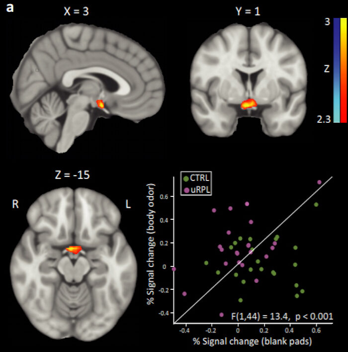 fMRI of Hypothalamus