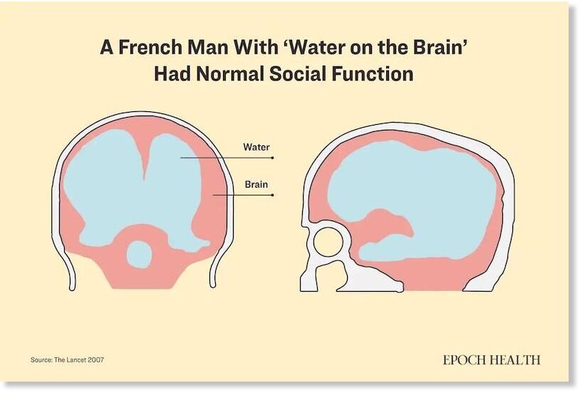 postnatal hydrocephalus