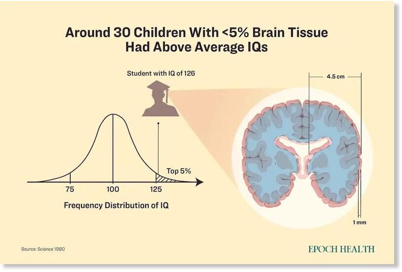 children with hydrocephalus