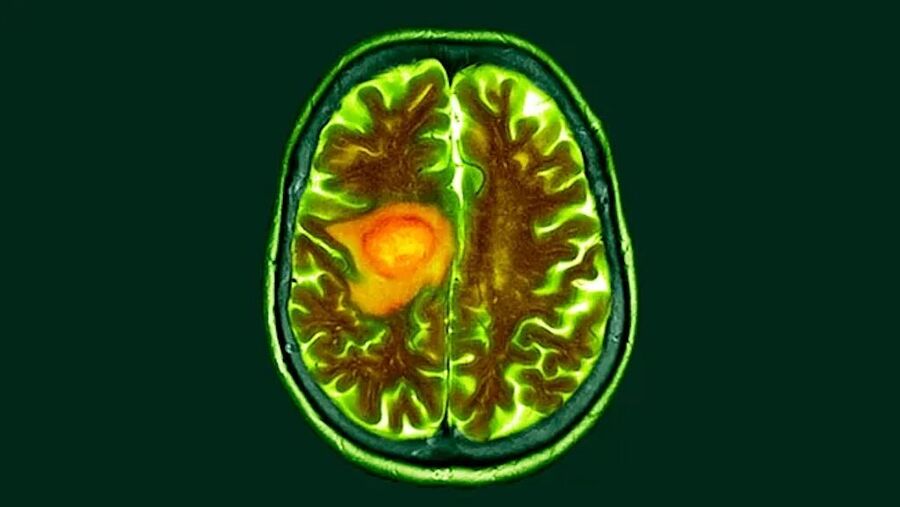Click to enlarge brain cancer cat scan